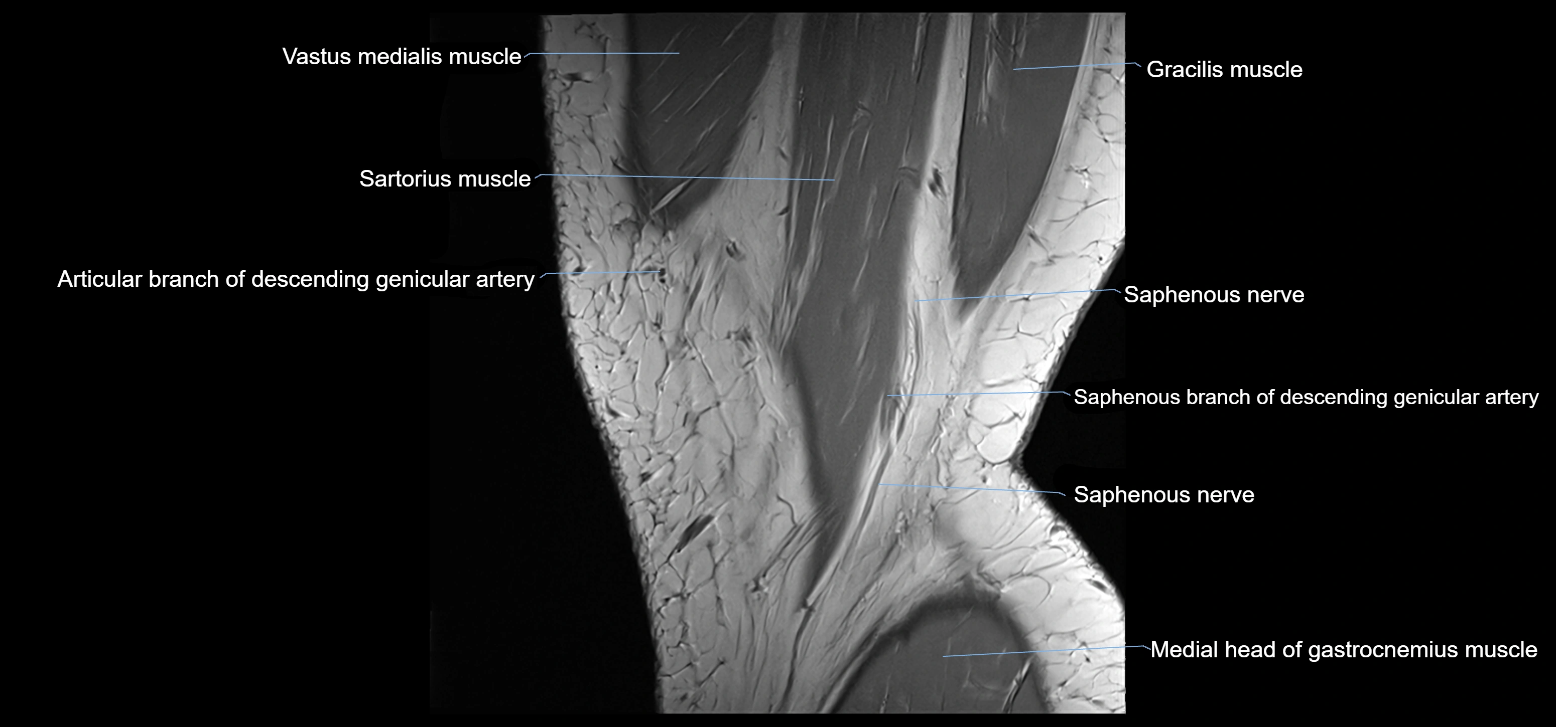 MRI knee sagittal cross sectional anatomy labelled 3T radiology image-00004.webp